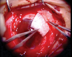 Figure 6. Intraoperative photograph shows the application of mitomycin C