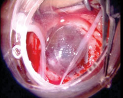 Figure 7. After the cornea and the perilimbal sclera are clean