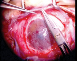 Figure 8. The human amniotic membrane with the cultured epithelial cells 