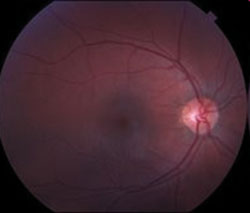 Figure 1. Fundus exam of the right eye