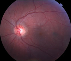 Figure 2. Fundus exam of the left eye