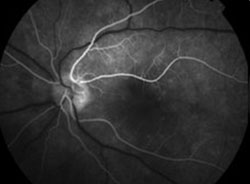 Figure 3. Early and late fluorescein angiogram of the left optic disc.