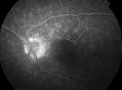 Figure 3. Early and late fluorescein angiogram of the left optic disc.