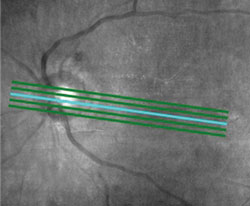 Figure 4. Ultrahigh-resolution OCT