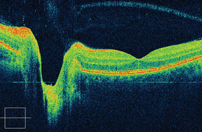 Figure 4. Ultrahigh-resolution OCT