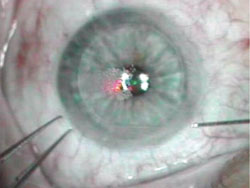 Figure 1. Limbal fixation