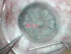 Figure 3. With a parallel movement of the dissection spatula toward the hinge and a very slight upward lift