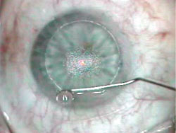 Figure 4. After the excimer ablation, place one to two drops of balanced salt solution near the hinge