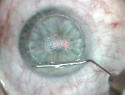 Figure 5. Carefully place the balance salt solution cannula under the flap