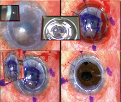 Figure 3. Intraoperative photograph