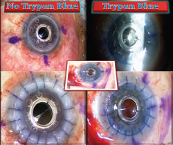 Figure 5. Completed intraoperative view of the Boston K-Pro