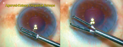 Figure 1. Agarwal-Katena forceps.