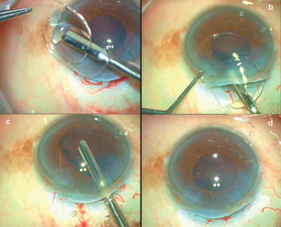 Figure 2. The IOL is gripped with the forceps