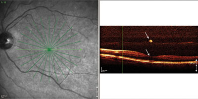 Figure 2. OCT slice is a scan from the same patient