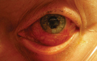 Figure 1a. Diffuse conjunctival injection and eyelid edema