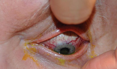 Figure 1b. Corkscrew dilated conjunctival vessels.