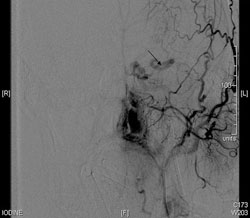 Figure 3. Left external carotid 