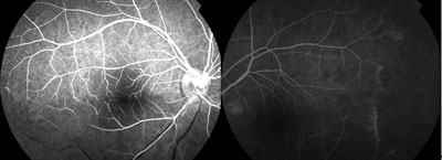 Figure 2. Fluorescein angiograms