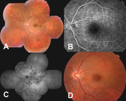 Figure 2. Multiple evanescent white dot syndrome.