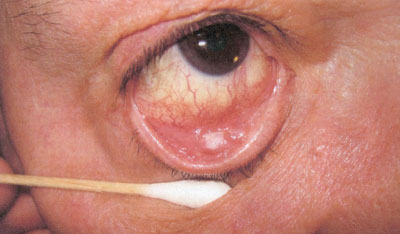 Figure 1. An elevated white plaque-like lesion