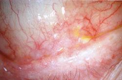 Figure 2. Six months after surgery, the patient was noted to have inferior forniceal foreshortening and symblepharon formation