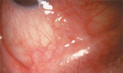 Figure 3. After mitomycin C treatment, there was a more distinctly leukoplakic lesion present