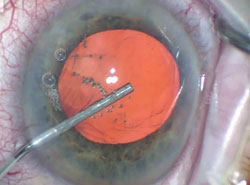 Healon 5 is injected into the anterior third of the anterior chamber