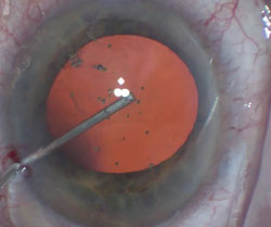 The cannula is placed on the anterior capsule in the center of the pupil