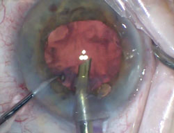 Bubbles in the anterior chamber remain trapped 