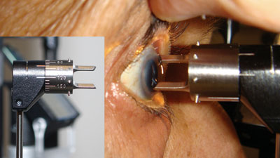 The steep corneal axis is marked