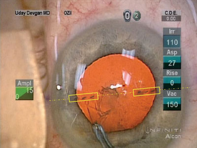 The corneal stromal puncture marks are seen in the yellow boxes