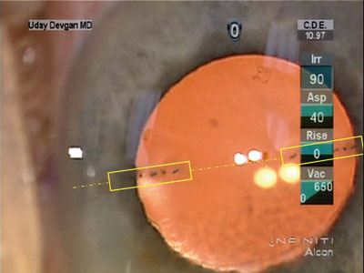 Alcon AcrySof SN6AT5 aspheric toric IOL is placed in the capsular bag 