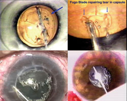 Figure 1. A round plasma blade capsulotomy is performed