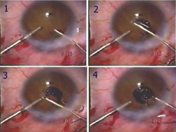 Figure 2. Tracing the blunt plasma blade probe over the iris 