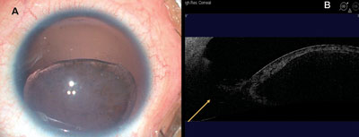 Figure 1. A: Congenital aniridia with subluxated cataractous lens.