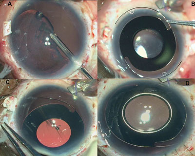 Figure 2. Glued iris prosthesis