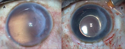 Figure 3. A: Clinical image of traumatic aniridia with aphakia