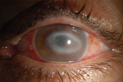 Figure 1. Slit lamp photo of the left eye 