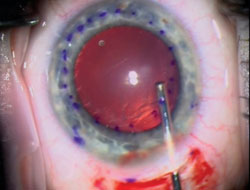 Figure 3. Scraping of the peripheral recipient bed