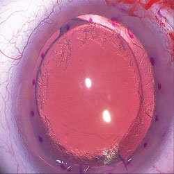 Figure 4. Completed band of peripheral recipient bed scraping