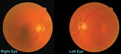 Figure 1. A patient with age-related macular degeneration and cataracts.