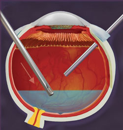 Figure 2. The endoscopic probe is on the right through the pars plana providing visualization of the vitrector on the left.