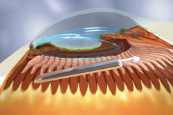 Figure 3. The endoscopic probe is shown ablating the ciliary processes through the pars plana.