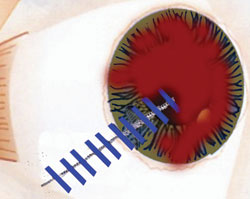 Figure 1. Suturing of cornea and scleral lacerations