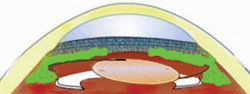 Figure 3. Phacoemulsification with IOL implantation