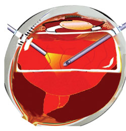 Figure 4. Bimanual vitrectomy is hampered by uncontrolled bleeding and poor visualization.