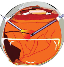 Figure 5. Perfluoro-octane flattens the retina