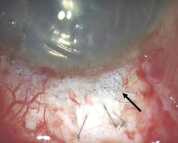 Figure 1. The escape of air bubbles (arrow) on injecting air