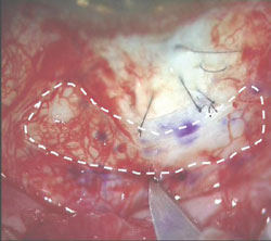 Figure 2. The rotational lamellar scleral flap is cut