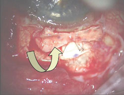 Figure 3. The lamellar scleral flap is rotated